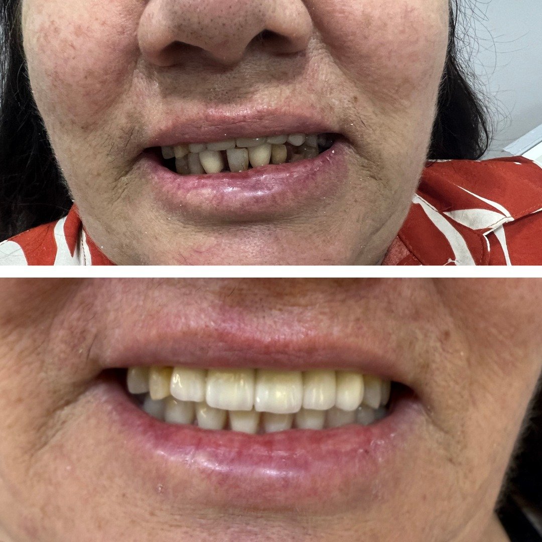 Antes e depois — Reabilitação oral · paciente real IEB