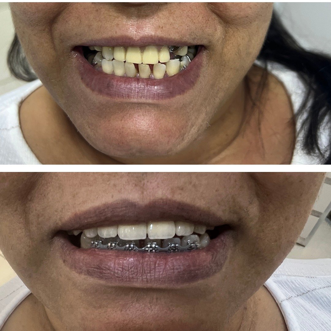 Antes e depois — Estética do sorriso · paciente real IEB